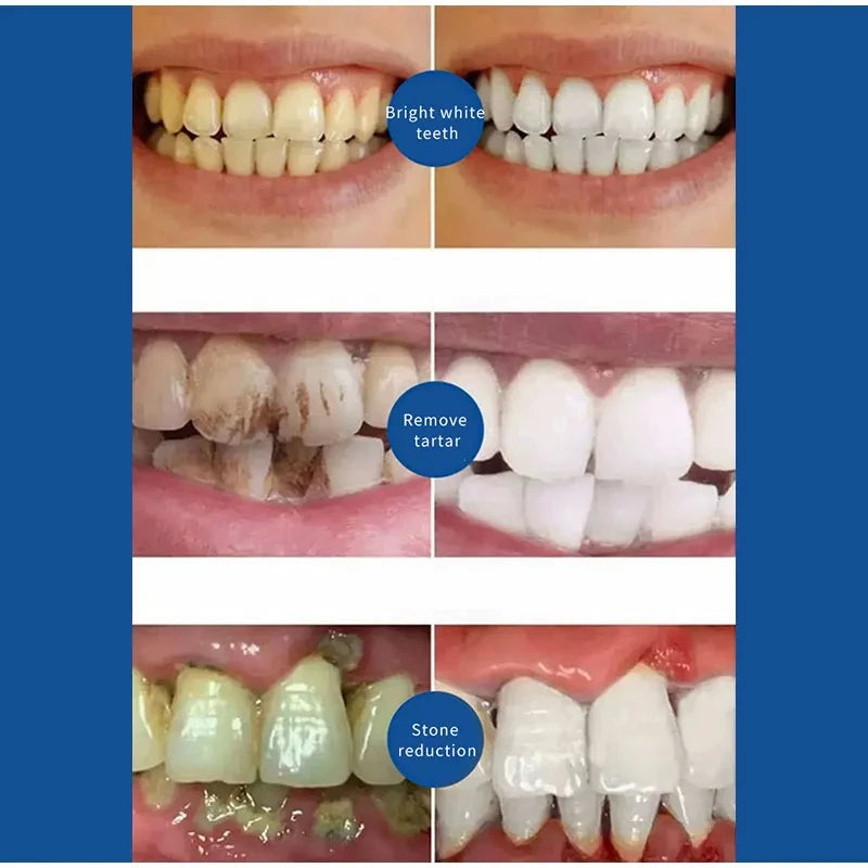 Pâte dentifrice pour le retrait du tartre dentaire, prévention de la mauvaise haleine, parodontite, anti-jaunissement, produits de soin de la bouche frais